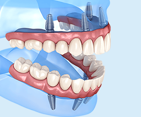 All On Four Diş İmplantı