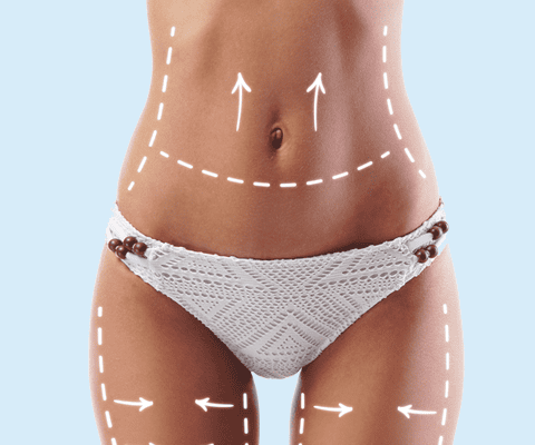 Liposuction